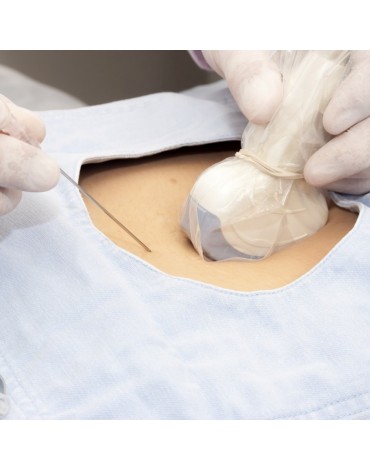 Marcaje bilateral de mamas por ultrasonido
