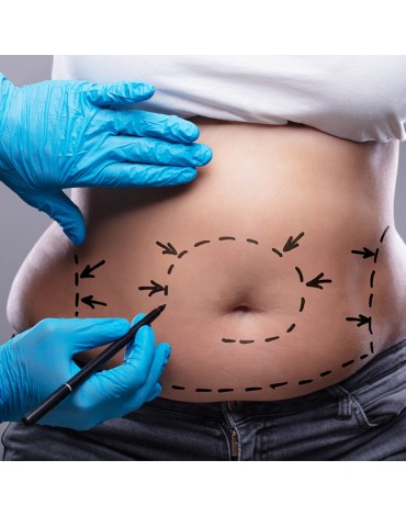 Lipoabdominoplastia