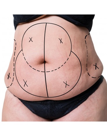 Lipoabdominoplastia