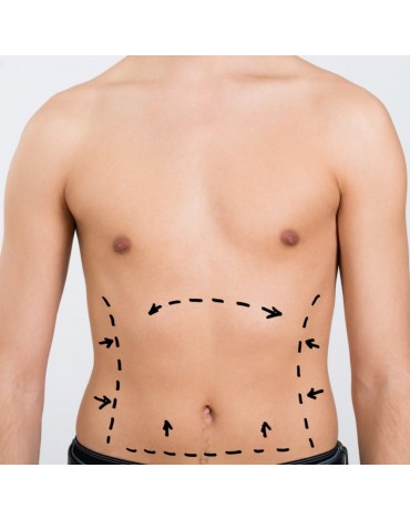 Anterior and lateral abdomen liposuction