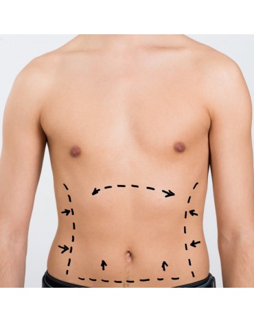 Liposucción de abdomen anterior y lateral