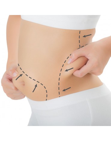 Liposucción de abdomen anterior, lateral  y espalda