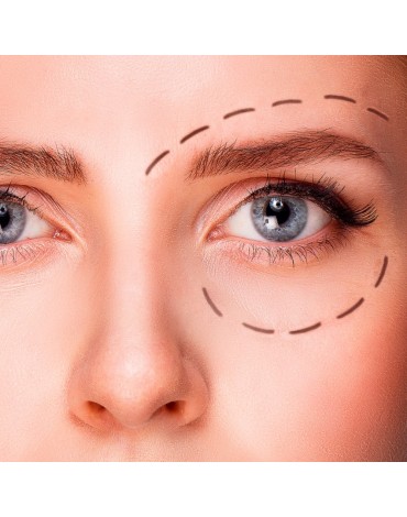 Blefaroplastia