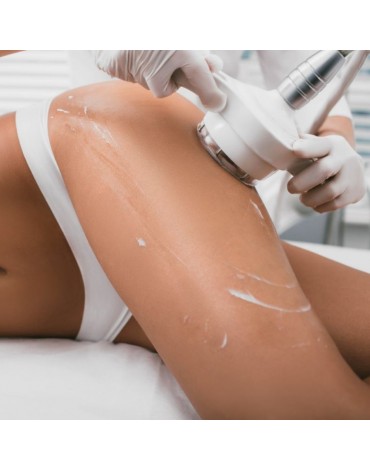 Laser assisted liposuction thigh