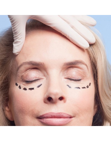 Lower blepharoplasty and treatment of transconjunctival fat bags