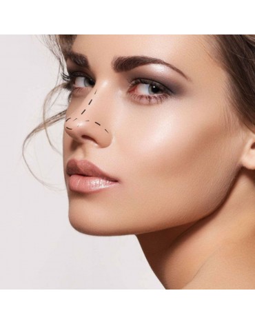 Rhinoplasty