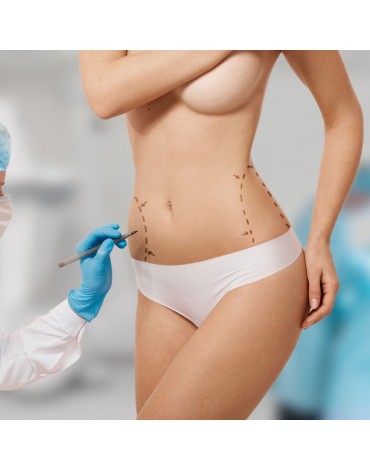 Abdominoplasty (with total anesthesia)