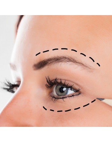 Upper and lower blepharoplasty (with local anesthesia and sedation)