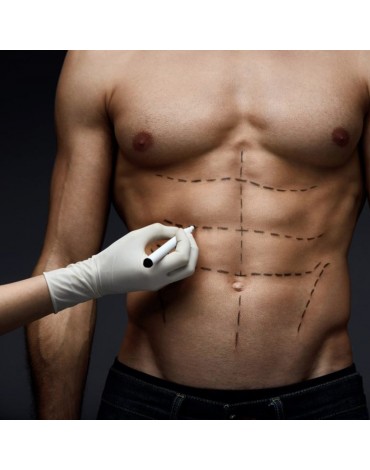 High definition liposuction (with total anesthesia)