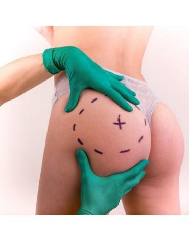 Buttock implant (with local anesthesia)