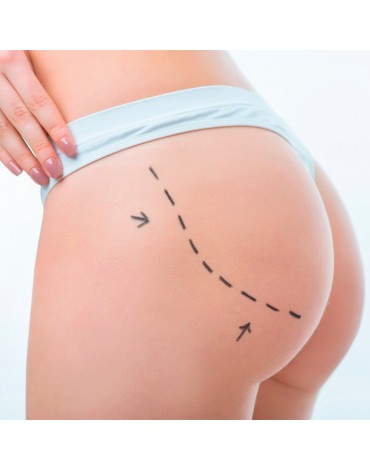 Buttock implant (with total anesthesia)