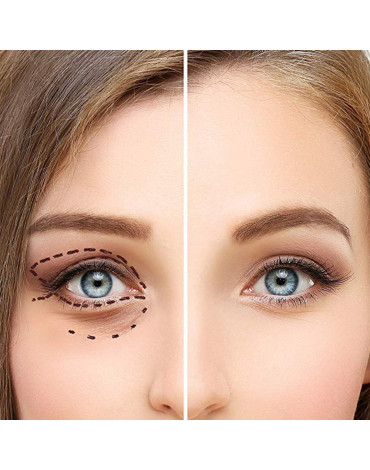 Upper and lower blepharoplasty (with local anesthesia and sedation)