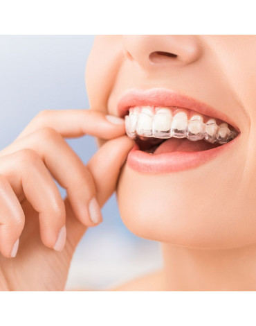 Invisalign (clear aligners)