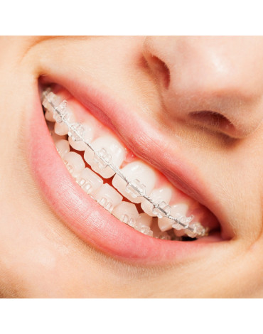 Orthodontics aesthetic brackets
