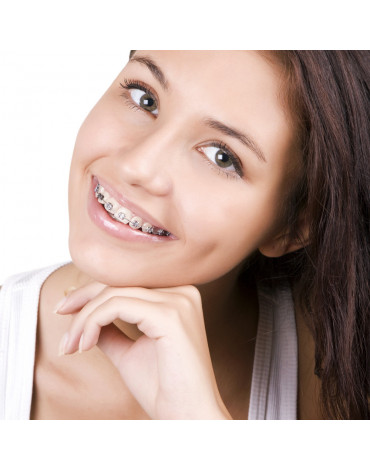 Orthodontics traditional brackets