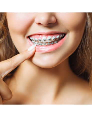 Conventional orthodontic treatment