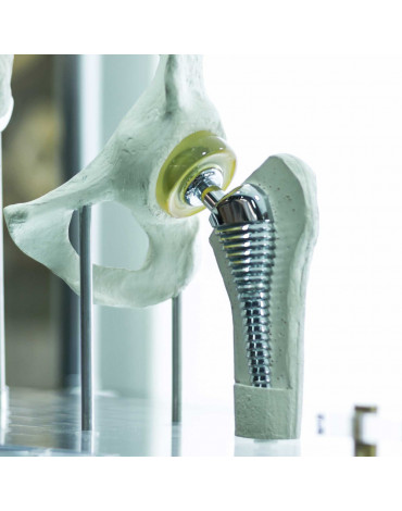 Hip joint replacement