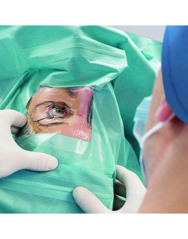 Cataract surgery with monofocal intraocular lens (one eye)