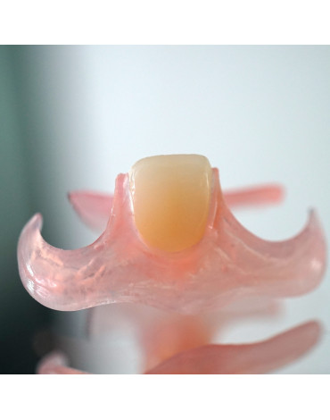 Prosthesis repair add tooth